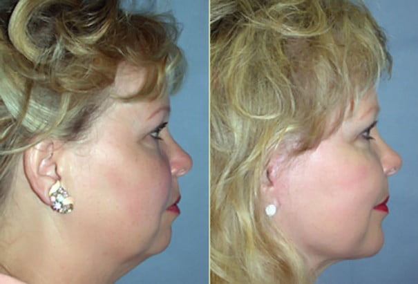 Before and after facelift, neck conturing, and chin implant