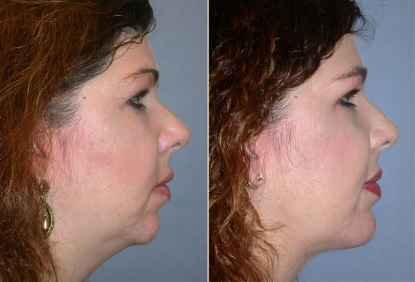 Before and after neck liposuction, chin implant, and laser skin resurfacing