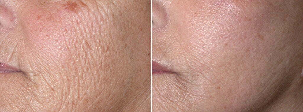 FX Laser Skin Resurfacing Patient 2