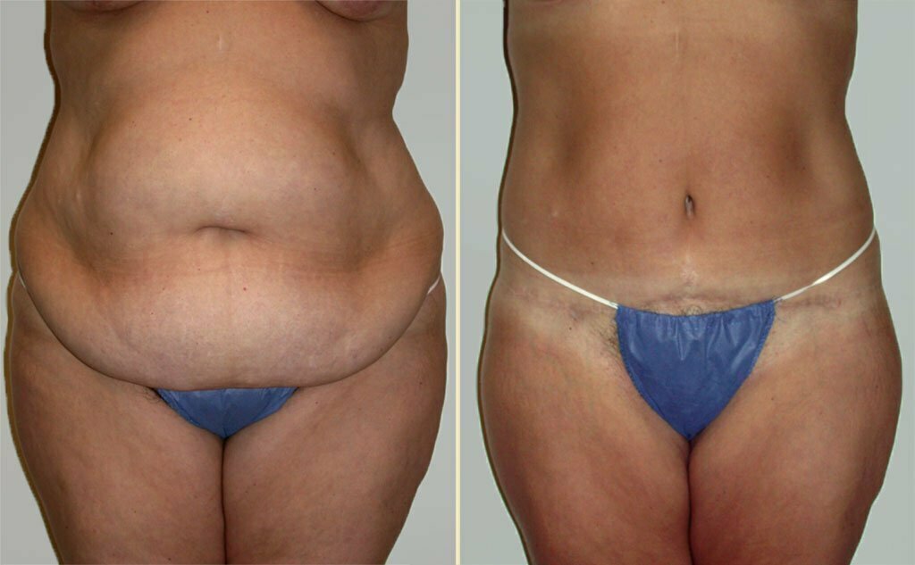 Patient H - 6 weeks Post-Operative Tummy Tuck Lateral Image — Dr