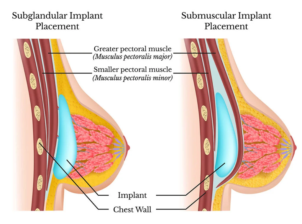 Odd Man Out - Why I Favor Breast Implant Placement Above the Muscle