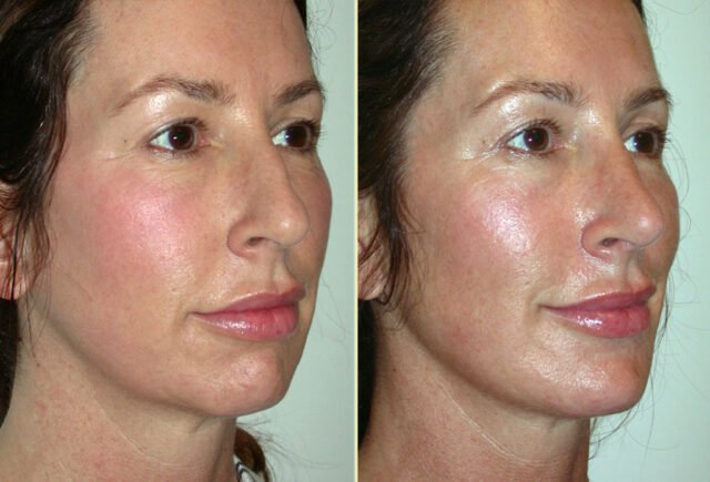 Before and after rhinoplasty and chin implant with Dr. Kiya Movassaghi