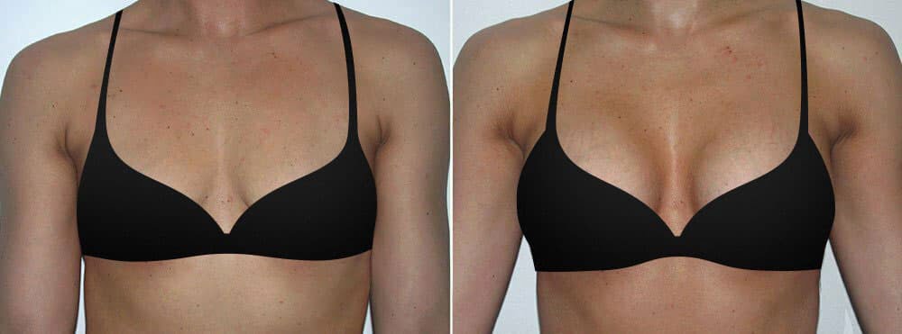 Affordable Breast augmentation - Leading Cosmetic Surgeons in