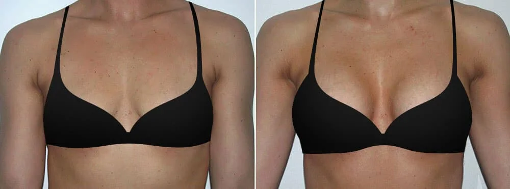 Looking for the Right Bra Size After Breast Augmentation? Try