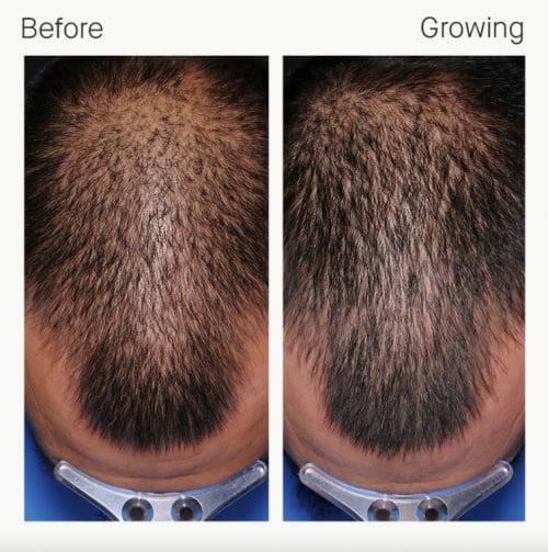 Man shown before and during Nutrafol supplement regimen for hair growth