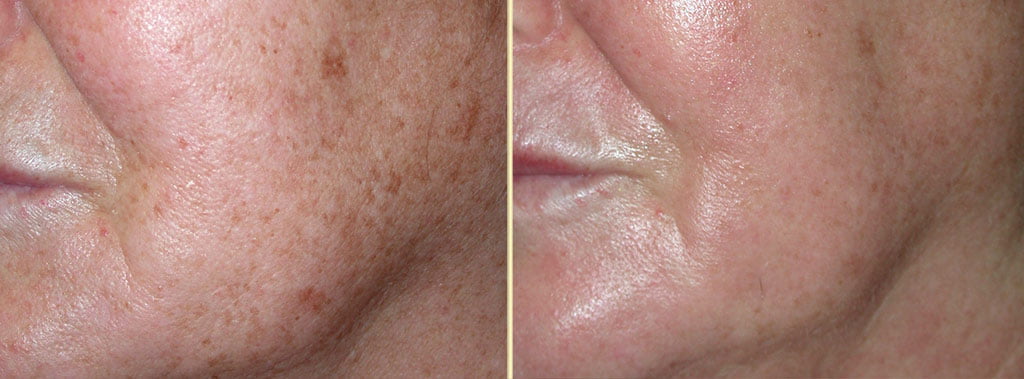 FX Laser Skin Resurfacing Patient 5