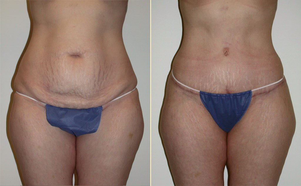 HLTA Tummy Tuck Patient 17