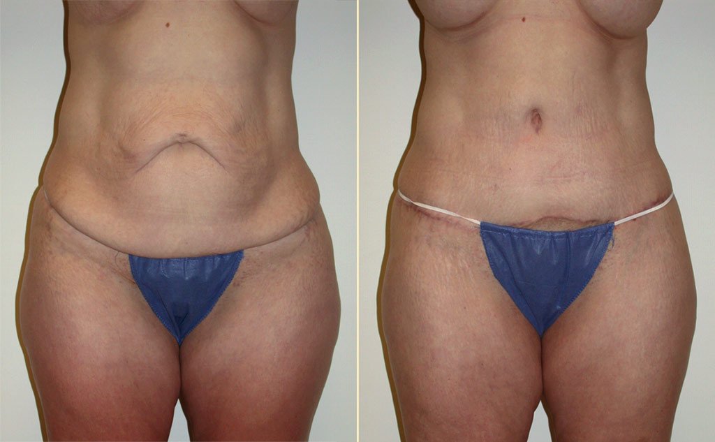 HLTA Tummy Tuck Patient 19