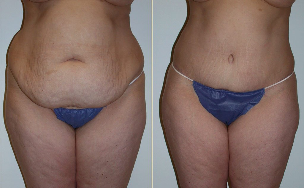 HLTA Tummy Tuck Patient 18