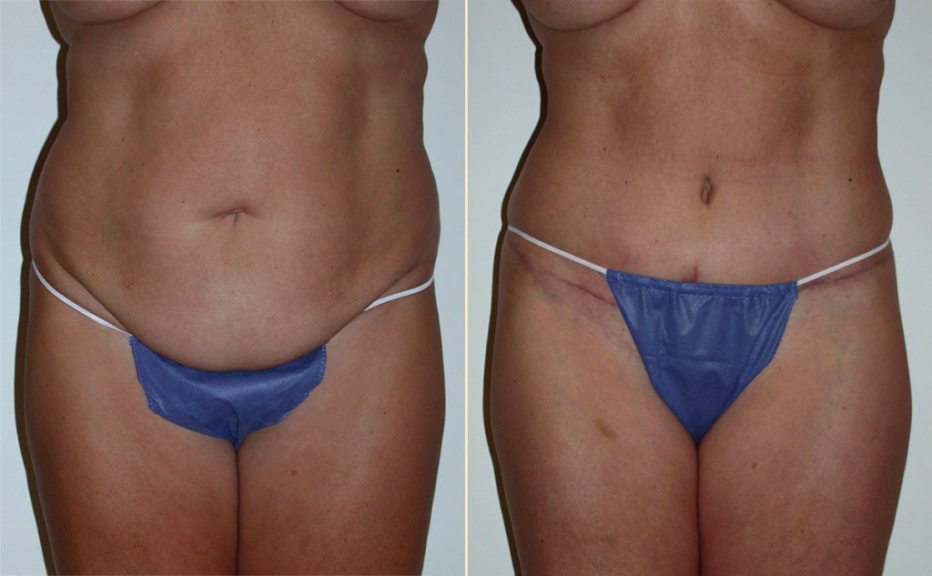 HLTA Tummy Tuck Patient 20