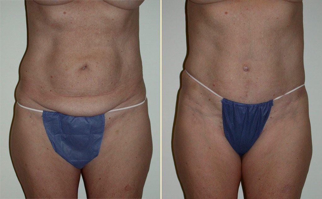 HLTA Tummy Tuck Patient 21