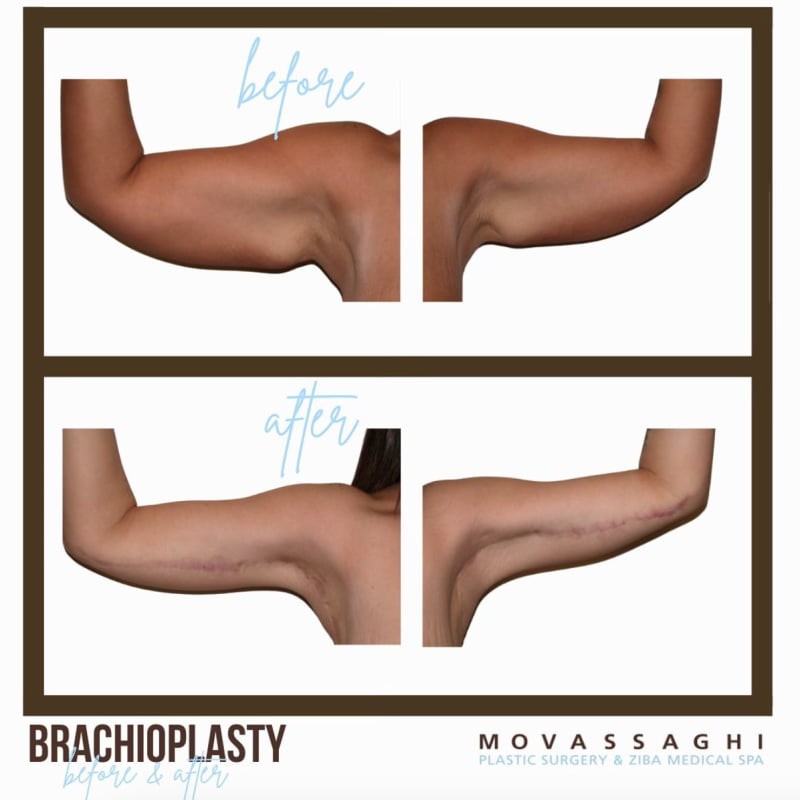 Before and after arm lift surgery with Eugene plastic surgeon Dr. Kiya Movassaghi