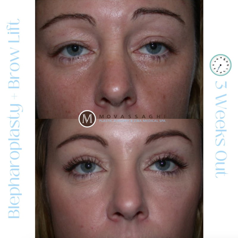 Before and after blepharoplasty and brow lift with Eugene facial plastic surgeon Dr. Kiya Movassaghi