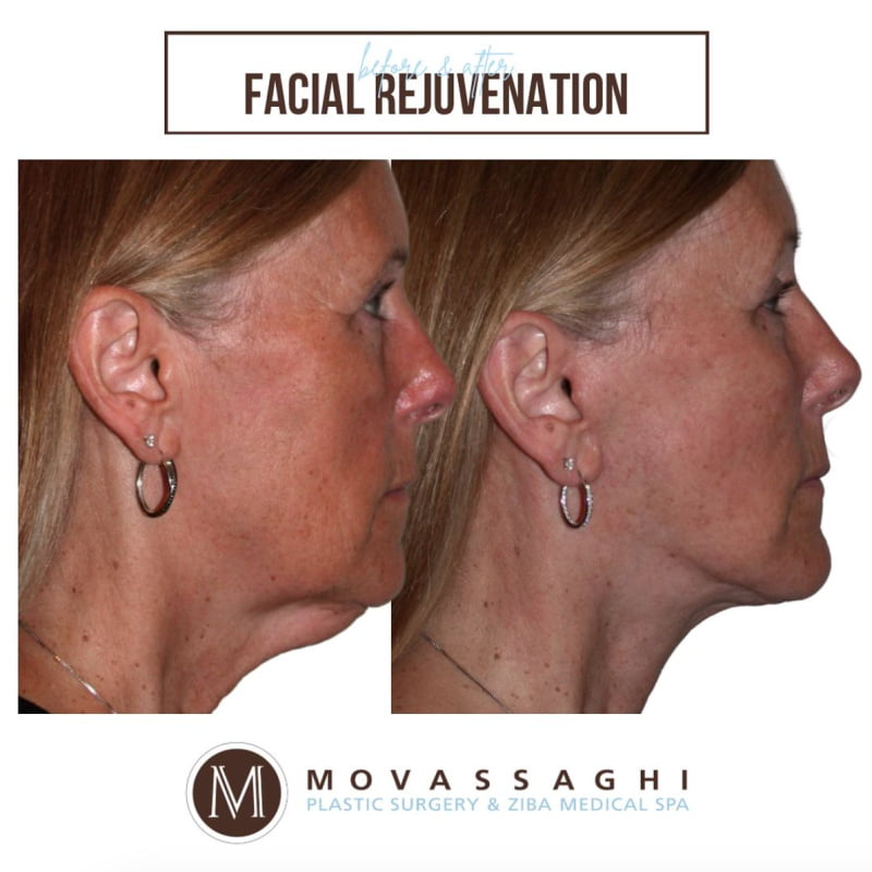 Before and after a facelift and neck lift with Eugene facelift surgeon Dr. Kiya Movassaghi