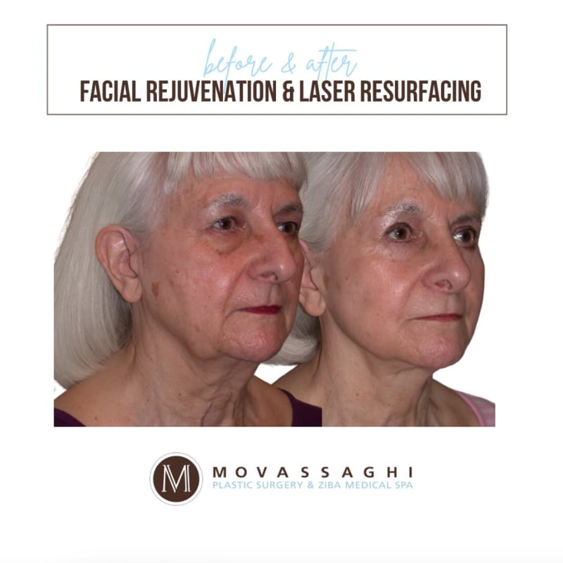 Before and after a facelift, neck lift, and laser skin resurfacing with Eugene plastic surgeon Dr. Kiya Movassaghi