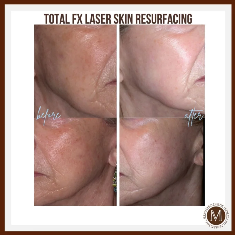 Close up of skin before and after Total FX laser skin resurfacing at Ziba Medical Spa in Eugene