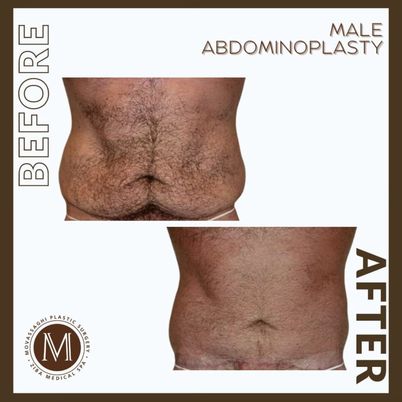 Man shown before and after a male abdominoplasty with Eugene plastic surgeon Dr. Kiya Movassaghi