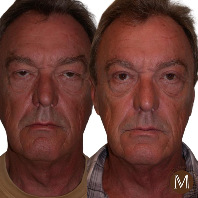 Man shown before and after blepharoplasty with a lateral brow lift with Eugene plastic surgeon Dr. Kiya Movassaghi