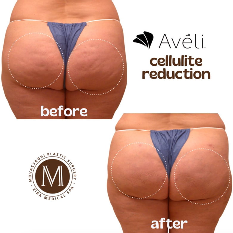 Before and after Aveli cellulite reduction treatment at Ziba Medical Spa in Eugene, OR