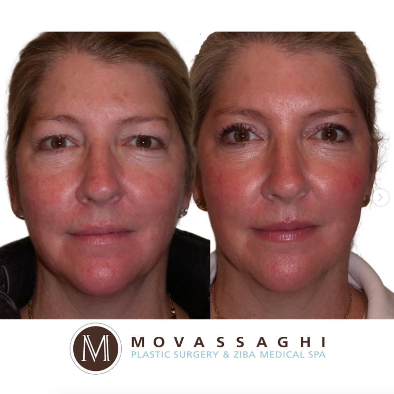 Before and after eyelid surgery with a lateral brow lift by Eugene plastic surgeon Dr. Kiya Movassaghi