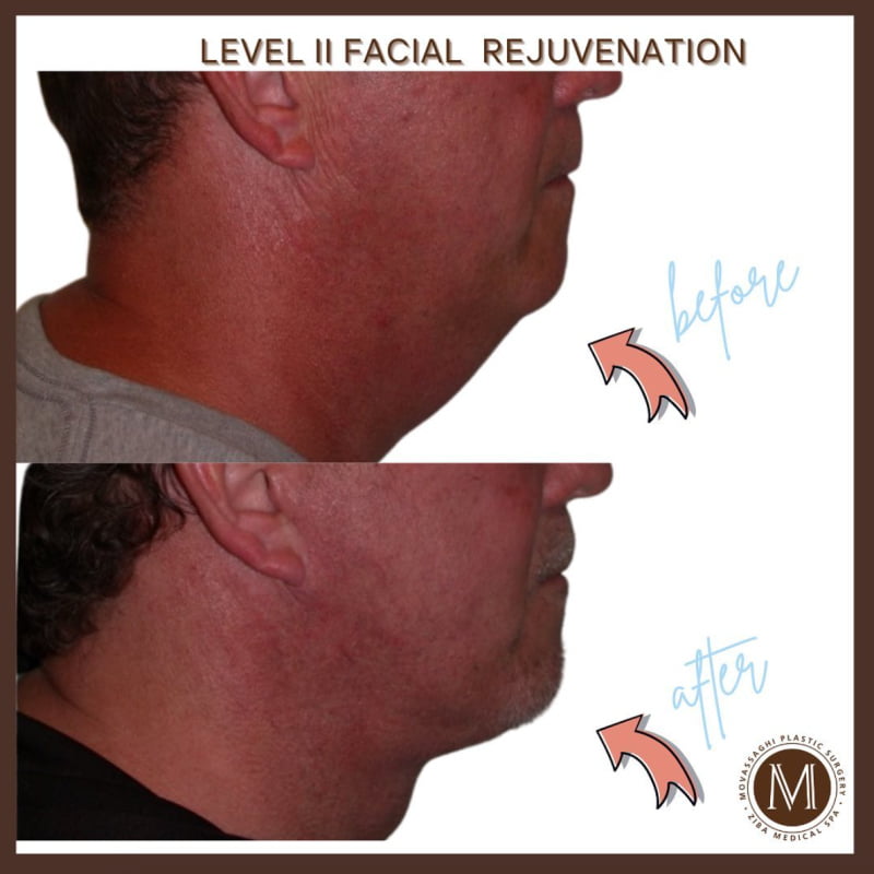 Man shown before and after a male facelift and neck lift with Eugene plastic surgeon Dr. Kiya Movassaghi