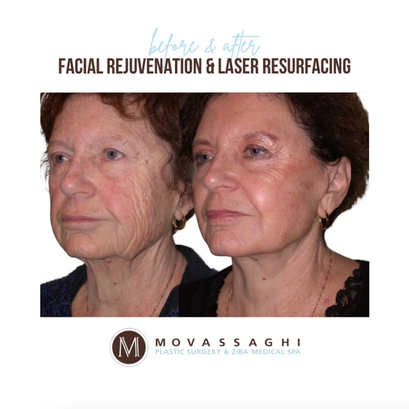 Before and after a facelift, neck lift, and laser skin resurfacing with Eugene plastic surgeon Dr. Kiya Movassaghi