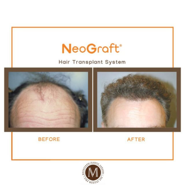 Man before and after NeoGraft hair restoration with Eugene plastic surgeon Dr. Kiya Movassaghi