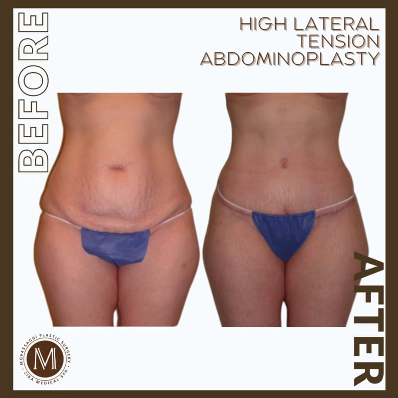 Before and after a high lateral tension abdominoplasty with Eugene plastic surgeon Dr. Kiya Movassaghi