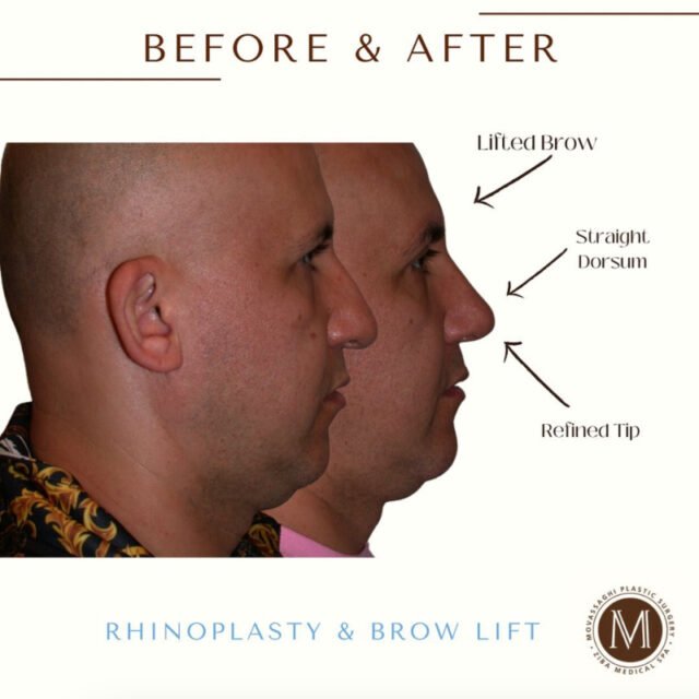 Before and after rhinoplasty with Eugene plastic surgeon Dr. Kiya Movassaghi