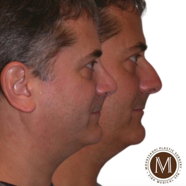 Before and after rhinoplasty with Eugene plastic surgeon Dr. Kiya Movassaghi