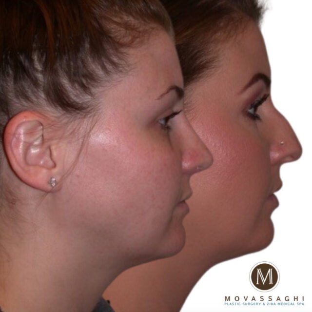 Before and after rhinoplasty with Eugene plastic surgeon Dr. Kiya Movassaghi