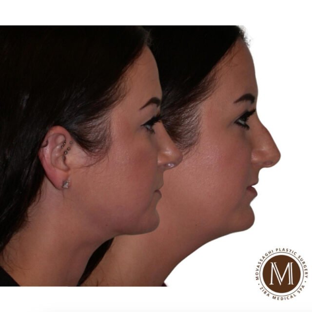 Before and after rhinoplasty with Eugene plastic surgeon Dr. Kiya Movassaghi