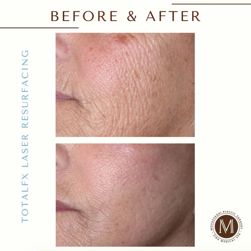 Close up of skin before and after Total FX laser skin resurfacing treatment with Eugene plastic surgeon Dr. Kiya Movassaghi