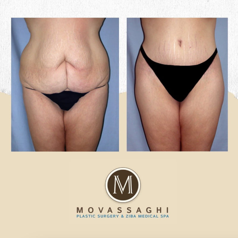 Before and after a tummy tuck with Eugene plastic surgeon Dr. Kiya Movassaghi