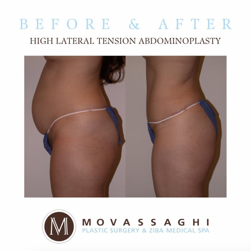 Before and after a High Lateral Tension Abdominoplasty with Eugene plastic surgeon Dr. Kiya Movassaghi