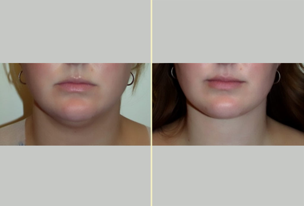 Neck Contouring Patient 11