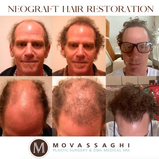 Man before and after NeoGraft hair restoration with Eugene plastic surgeon Dr. Kiya Movassaghi