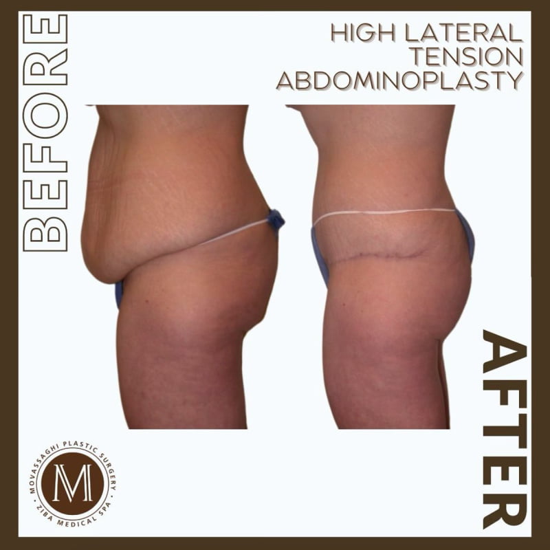 Before and after a high lateral tension abdominoplasty with Eugene plastic surgeon Dr. Kiya Movassaghi