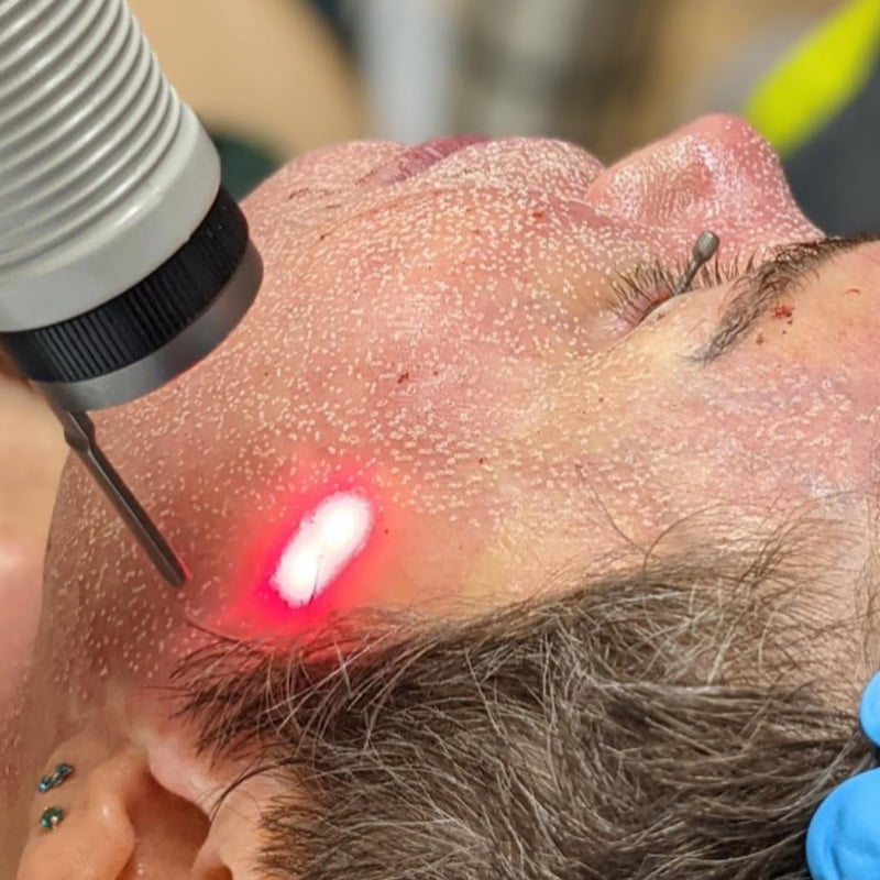 Close up of patient during a Total FX laser skin resurfacing treatment at Ziba Medical Spa in Eugene