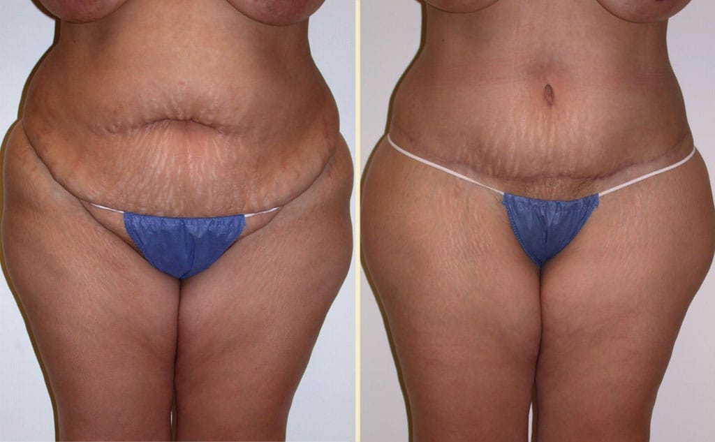 HLTA Tummy Tuck Patient 22