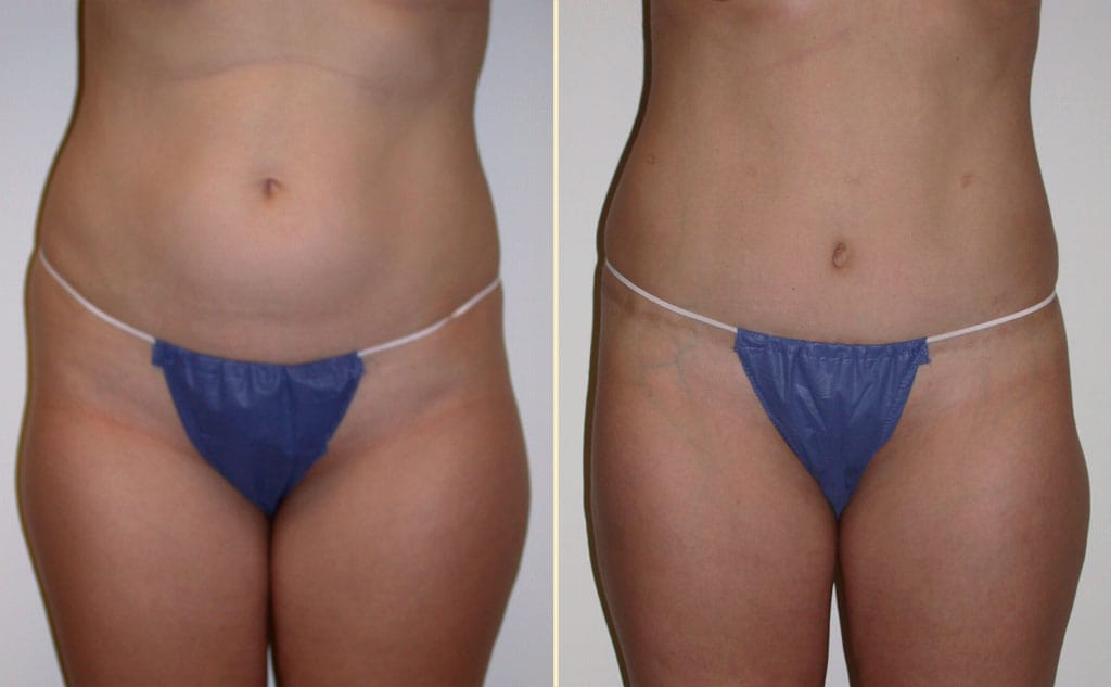 HLTA Tummy Tuck Patient 23