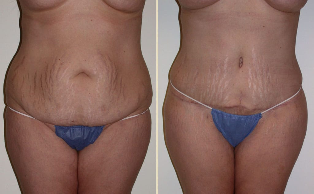 HLTA Tummy Tuck Patient 24