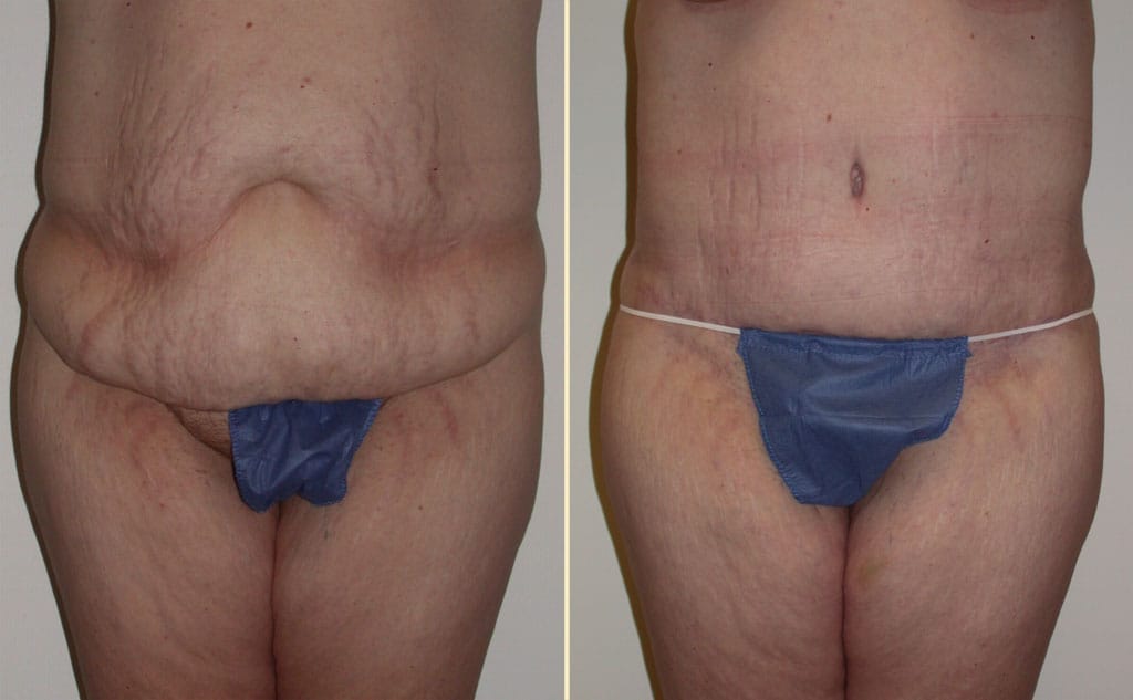 HLTA Tummy Tuck Patient 25