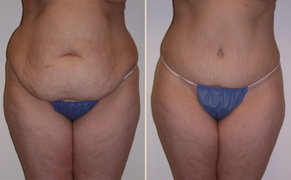 HLTA Tummy Tuck Patient 26