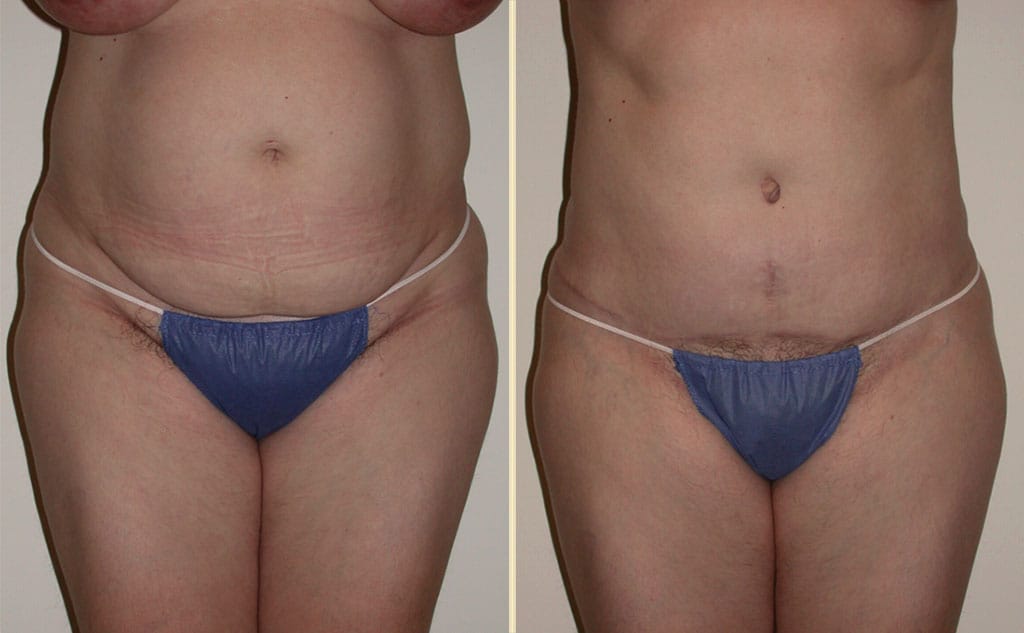 HLTA Tummy Tuck Patient 27