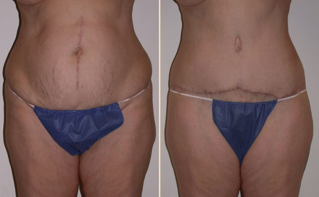 HLTA Tummy Tuck Patient 28