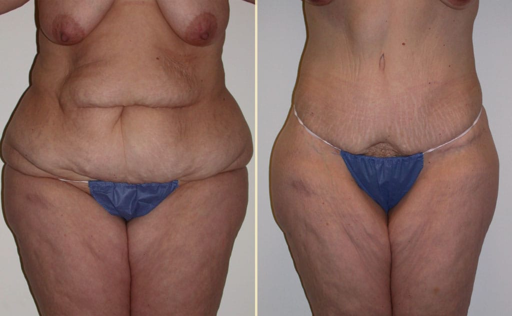 HLTA Tummy Tuck Patient 31