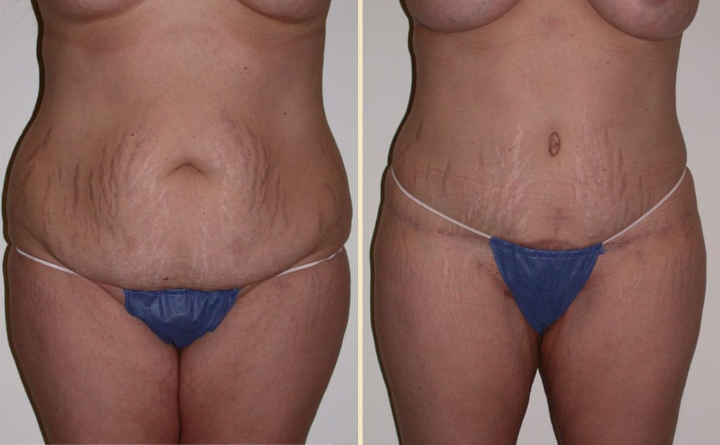 HLTA Tummy Tuck Patient 32