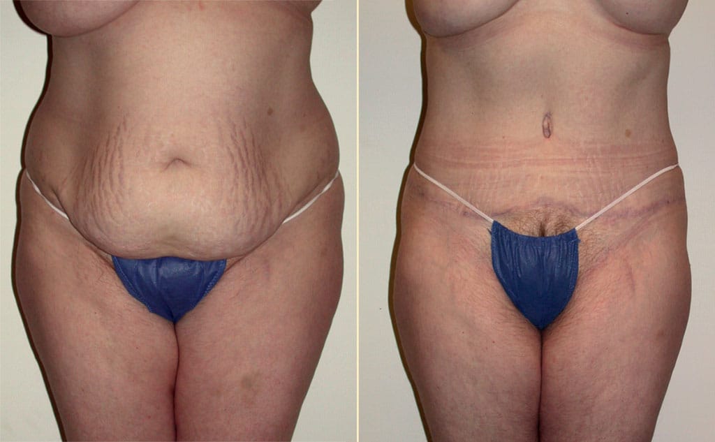 HLTA Tummy Tuck Patient 30